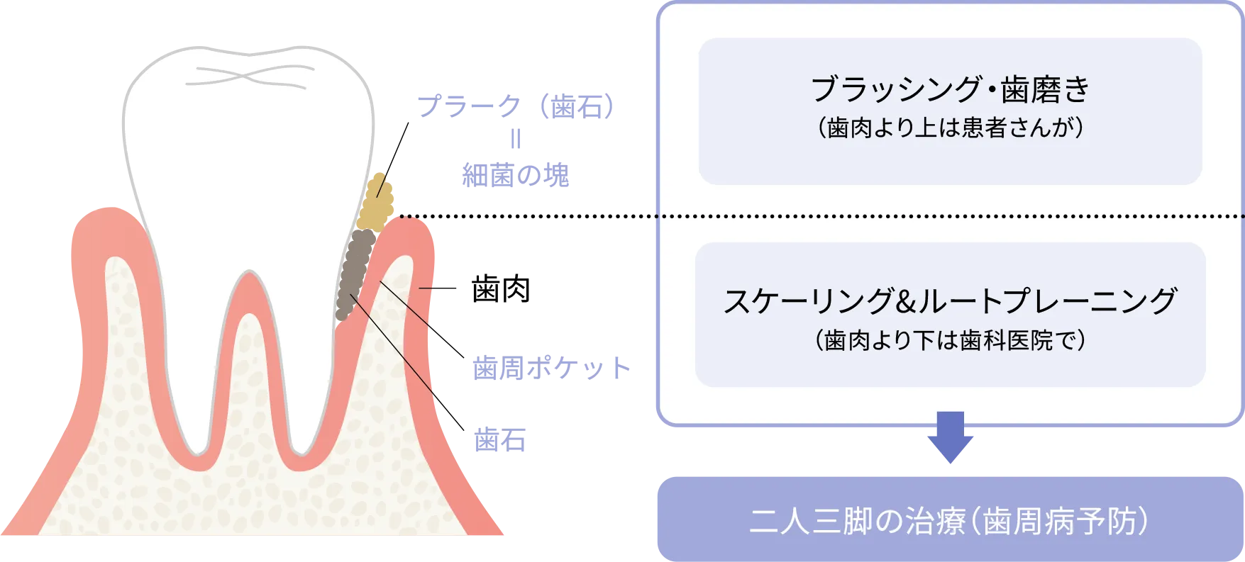 歯周ポケットの汚れを除去し歯茎の環境を整える