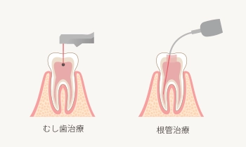 レーザー治療のイメージ画像