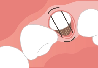 歯槽提増大術の治療03